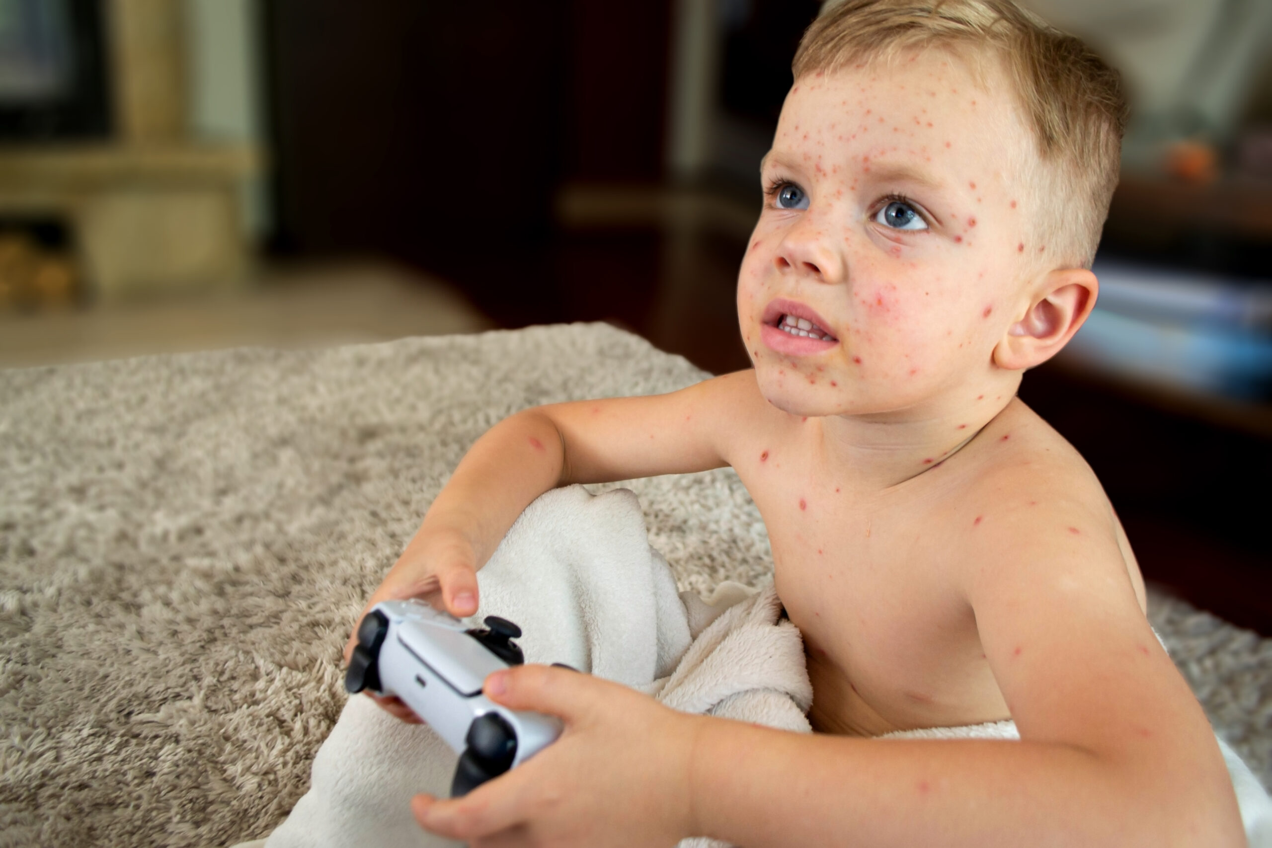 Young child with visible chickenpox rash on the face and body, playing video games, highlighting a common childhood illness